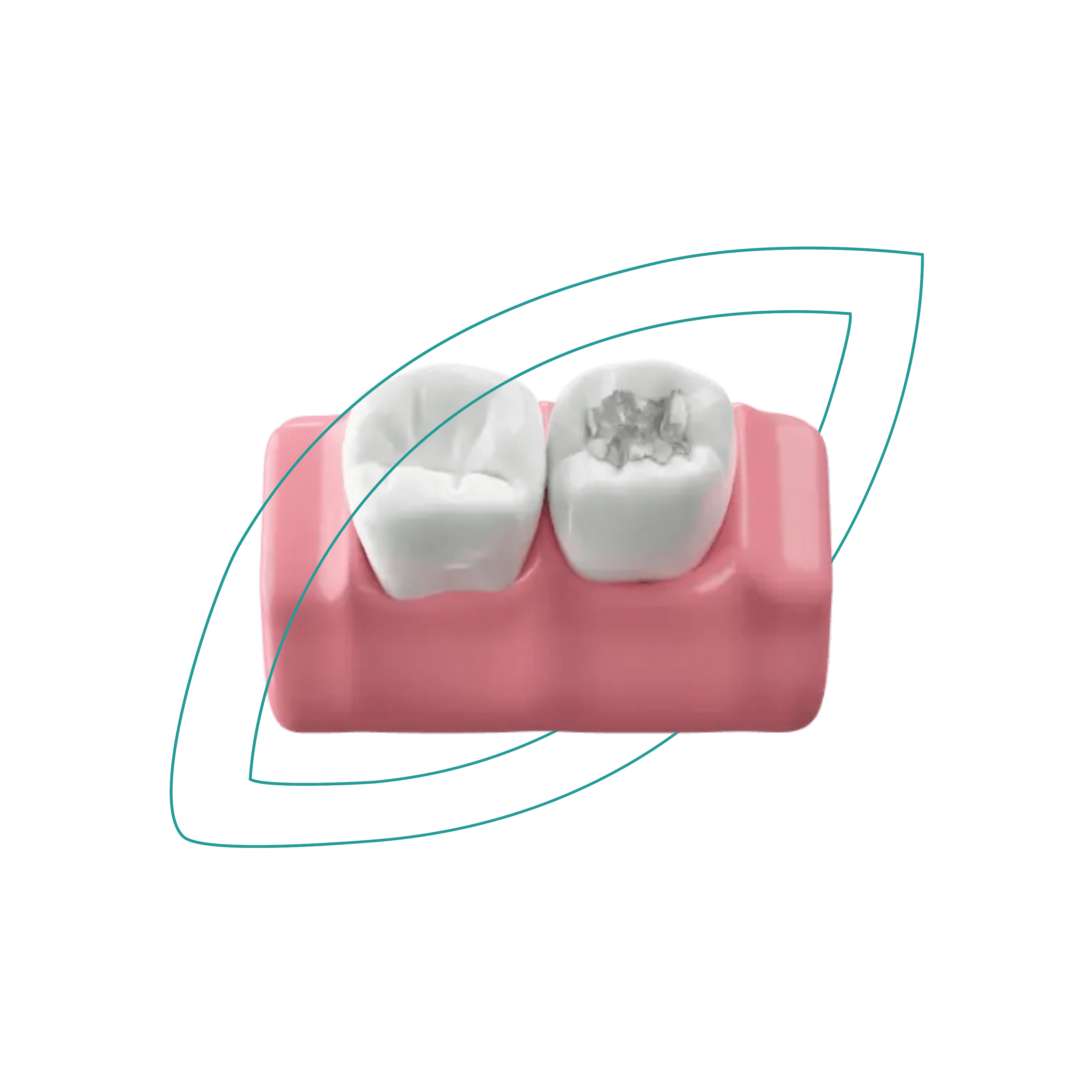 Servicio de Caries y Limpieza